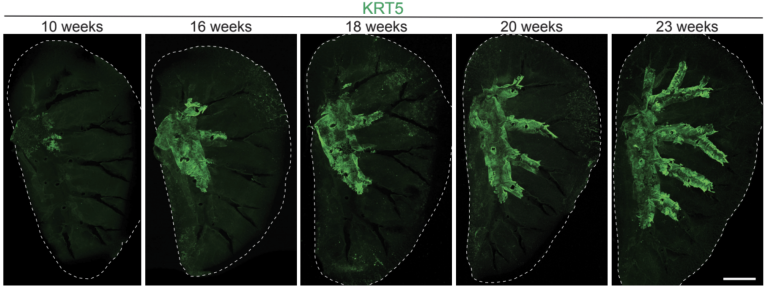 Científicos hallan ‘células mutantes‘ que serían el origen del cáncer de pulmón