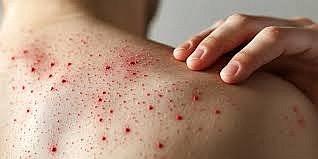 El sarampión: una nueva prueba para Chile