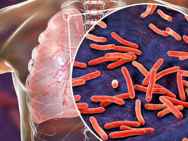 Día Mundial de la Tuberculosis: especialistas U. de Chile alertan sobre la urgencia de detectarla a tiempo